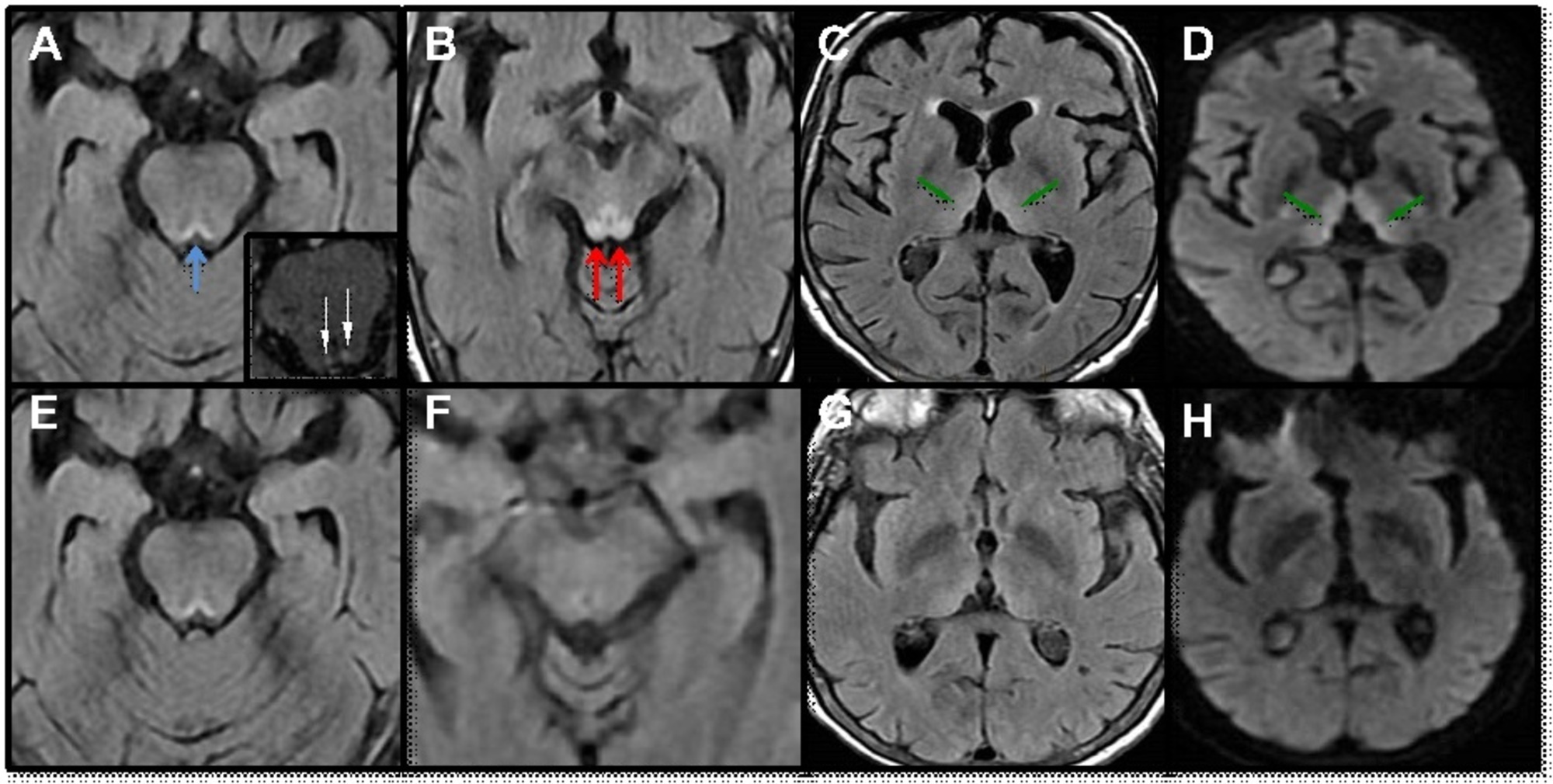 ウェルニッケ 脳症 mri